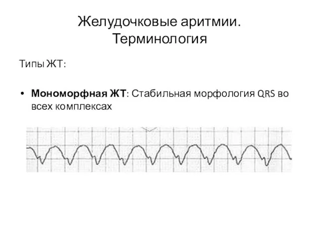 Желудочковые аритмии. Терминология Типы ЖТ: Мономорфная ЖТ: Стабильная морфология QRS во всех комплексах