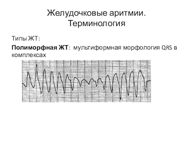 Желудочковые аритмии. Терминология Типы ЖТ: Полиморфная ЖТ: мультиформная морфология QRS в комплексах