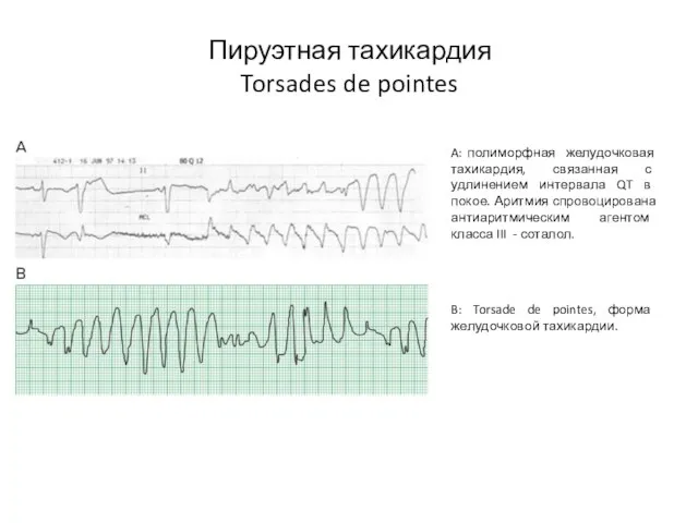 Пируэтная тахикардия Torsades de pointes A: полиморфная желудочковая тахикардия, связанная с