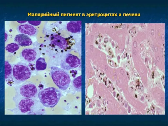 Малярийный пигмент в эритроцитах и печени