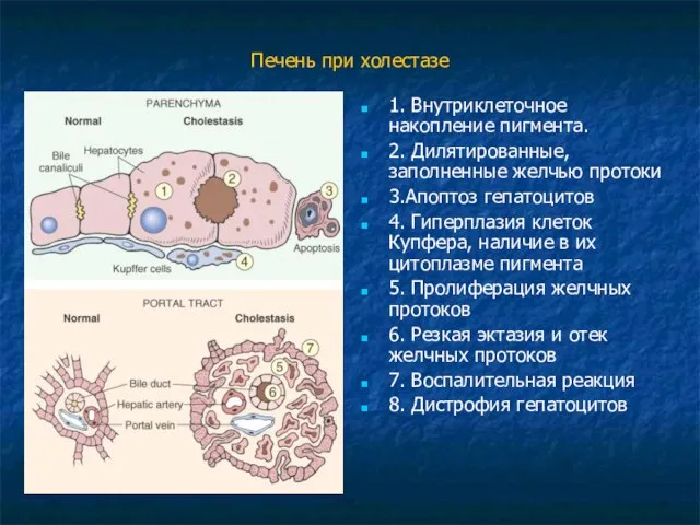Печень при холестазе 1. Внутриклеточное накопление пигмента. 2. Дилятированные, заполненные желчью