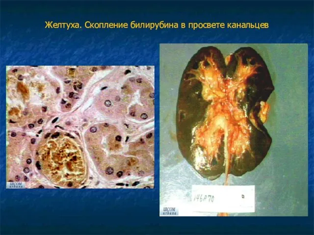 Желтуха. Скопление билирубина в просвете канальцев