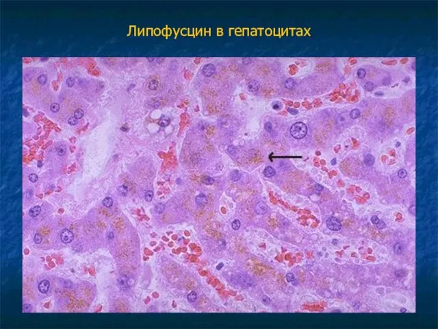 Липофусцин в гепатоцитах