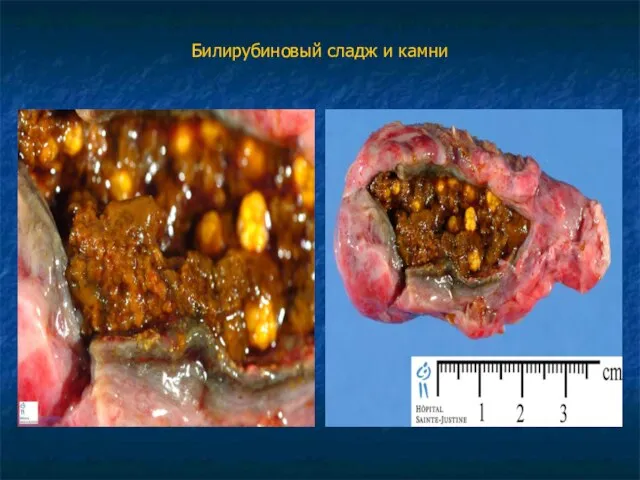 Билирубиновый сладж и камни