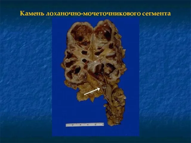 Камень лоханочно-мочеточникового сегмента