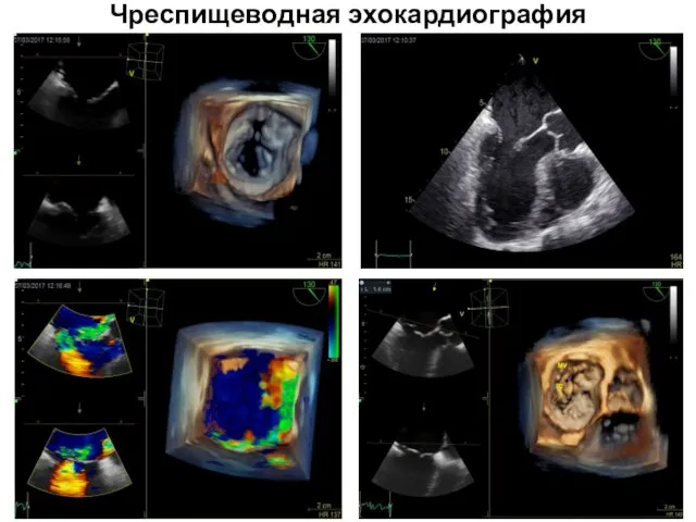 Чреспищеводная эхокардиография