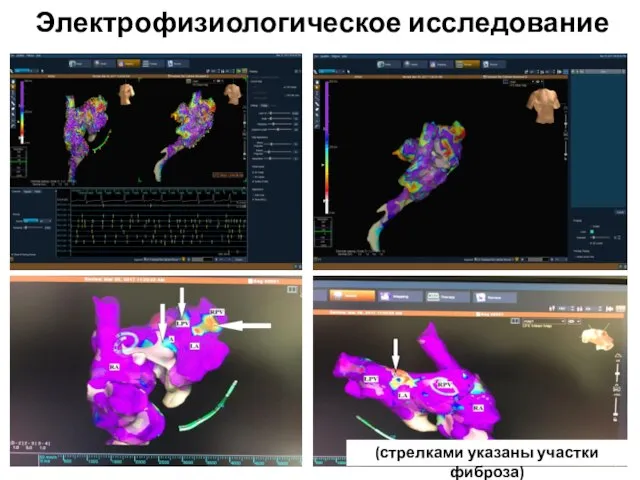 Электрофизиологическое исследование (стрелками указаны участки фиброза)