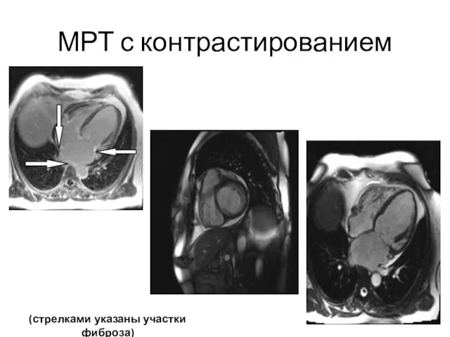 МРТ с контрастированием (стрелками указаны участки фиброза)