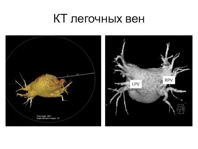 КТ легочных вен RPV LPV