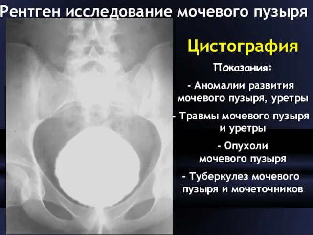 Цистография Показания: Аномалии развития мочевого пузыря, уретры Травмы мочевого пузыря и