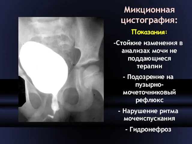 Микционная цистография: Показания: Стойкие изменения в анализах мочи не поддающиеся терапии