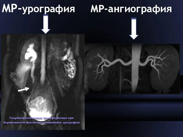 МР-урография МР-ангиография