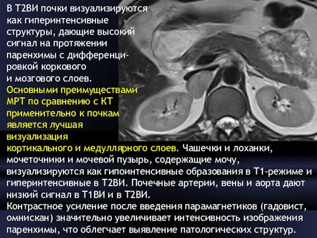 В Т2ВИ почки визуализируются как гиперинтенсивные структуры, дающие высокий сигнал на