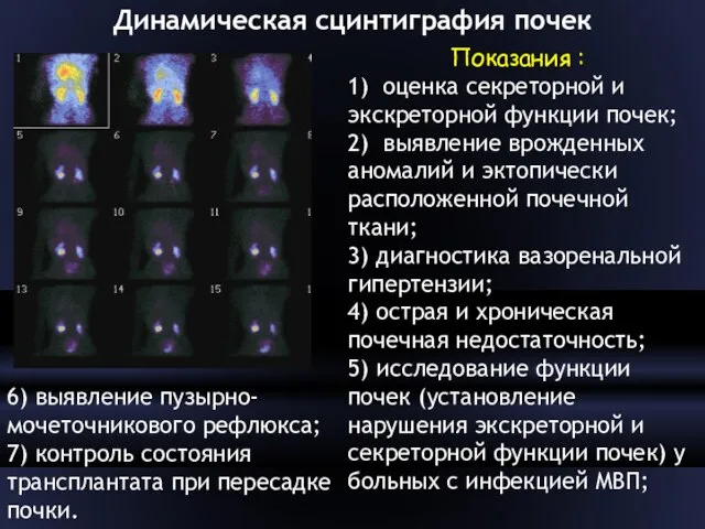 Динамическая сцинтиграфия почек Показания : 1) оценка секреторной и экскреторной функции