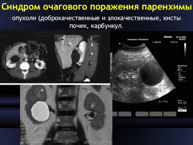 Синдром очагового поражения паренхимы опухоли (доброкачественные и злокачественные, кисты почек, карбункул.