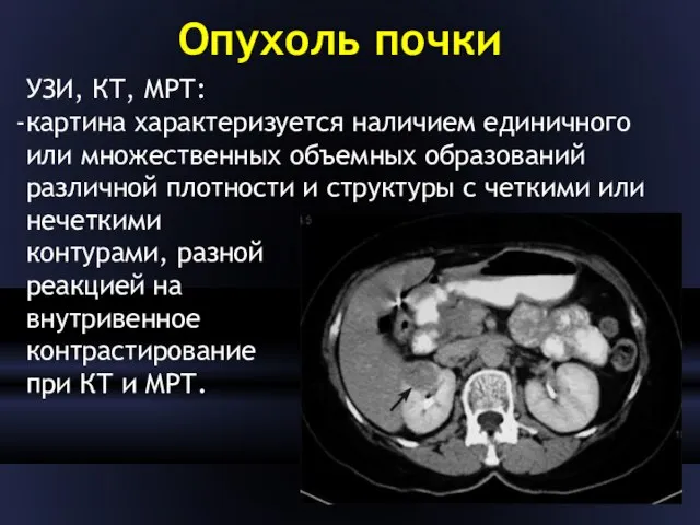 Опухоль почки УЗИ, КТ, МРТ: картина характеризуется наличием единичного или множественных