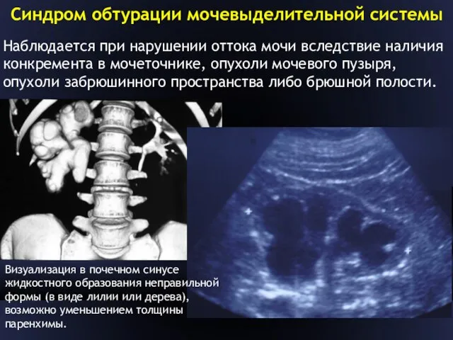 Синдром обтурации мочевыделительной системы Наблюдается при нарушении оттока мочи вследствие наличия