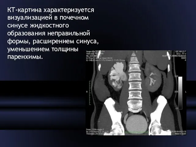 КТ-картина характеризуется визуализацией в почечном синусе жидкостного образования неправильной формы, расширением синуса, уменьшением толщины паренхимы.