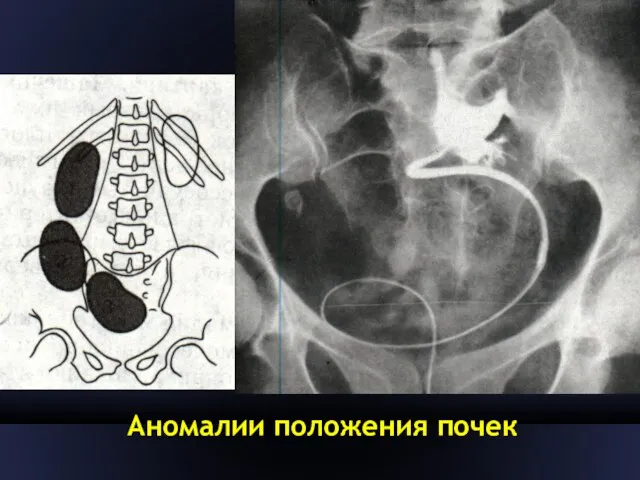 Аномалии положения почек