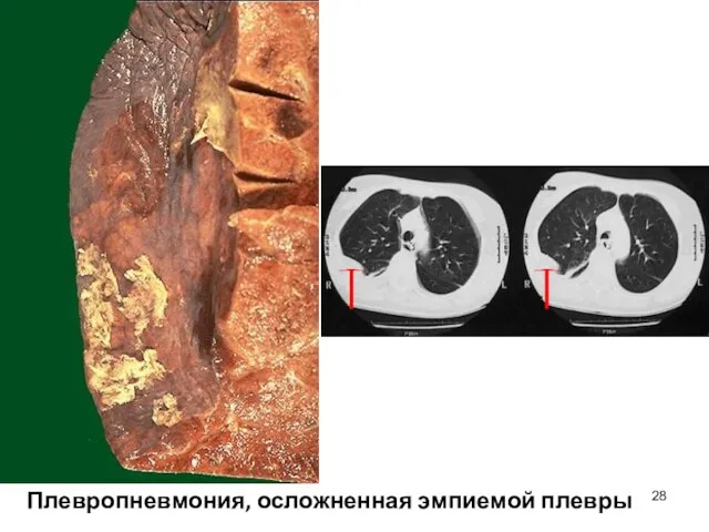 Плевропневмония, осложненная эмпиемой плевры