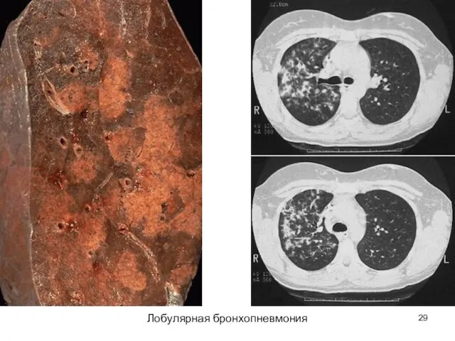 Лобулярная бронхопневмония