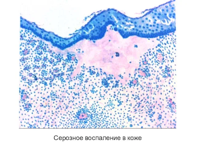 Серозное воспаление в коже