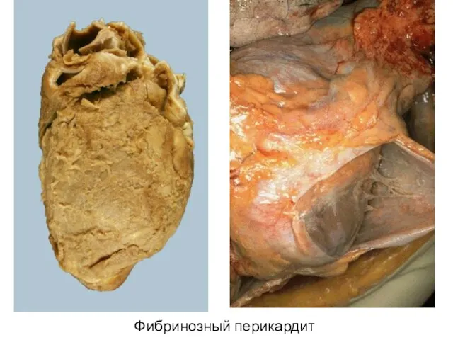 Фибринозный перикардит