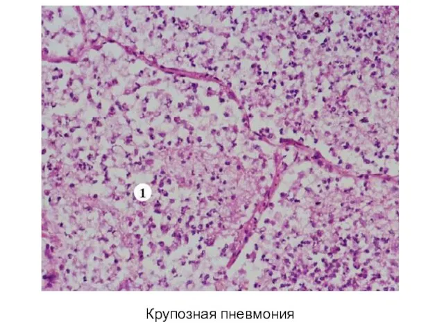 Крупозная пневмония