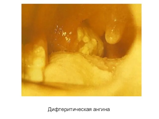 Дифтеритическая ангина