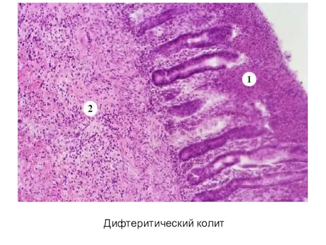 Дифтеритический колит