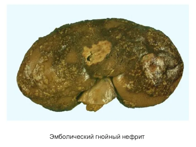 Эмболический гнойный нефрит