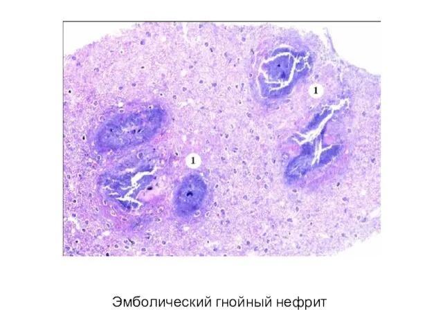 Эмболический гнойный нефрит