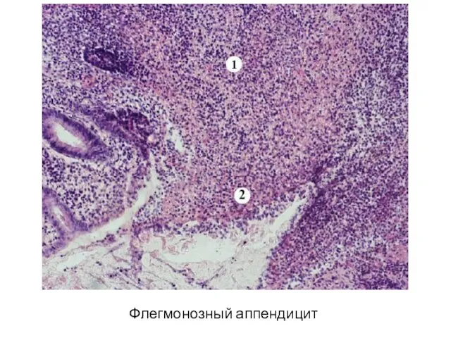 Флегмонозный аппендицит