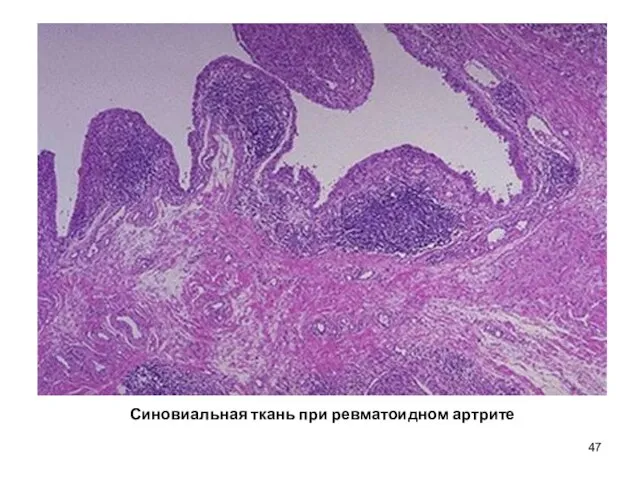 Синовиальная ткань при ревматоидном артрите