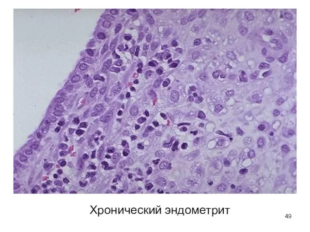 Хронический эндометрит