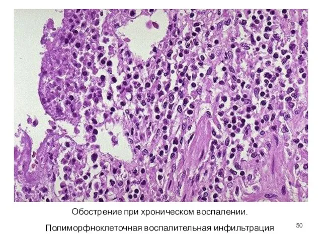 Обострение при хроническом воспалении. Полиморфноклеточная воспалительная инфильтрация