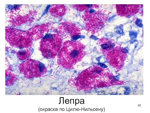 Лепра (окраска по Цилю-Нильсену)