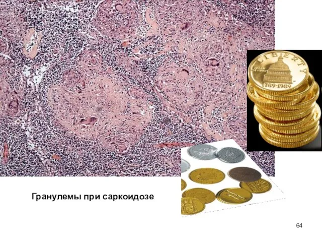 Гранулемы при саркоидозе