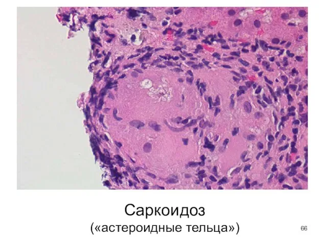 Саркоидоз («астероидные тельца»)