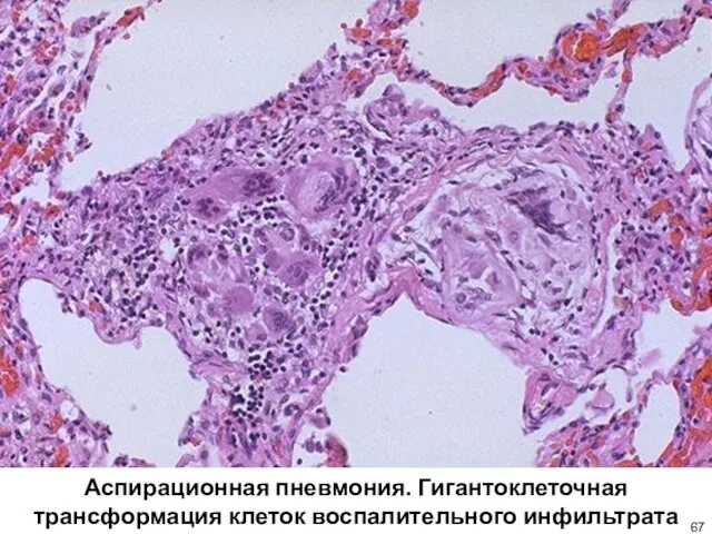 Аспирационная пневмония. Гигантоклеточная трансформация клеток воспалительного инфильтрата