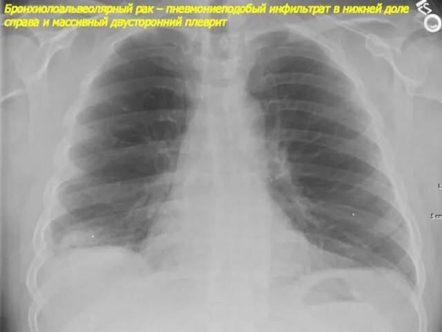 Бронхиолоальвеолярный рак – пневмониеподобый инфильтрат в нижней доле справа и массивный двусторонний плеврит