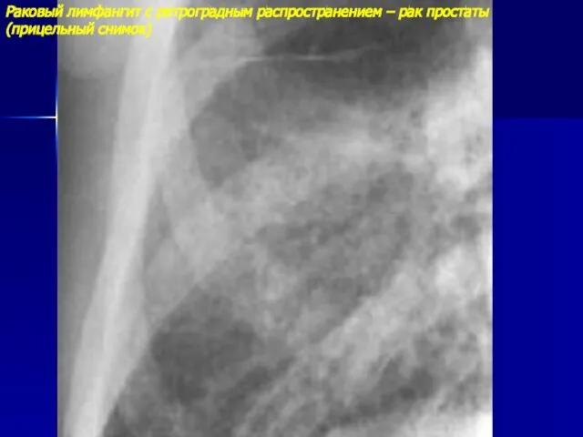 Раковый лимфангит с ретроградным распространением – рак простаты (прицельный снимок)