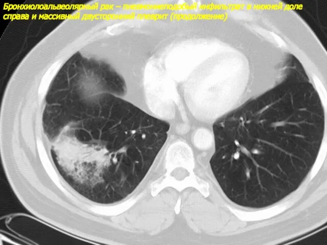 Бронхиолоальвеолярный рак – пневмониеподобый инфильтрат в нижней доле справа и массивный двусторонний плеврит (продолжение)