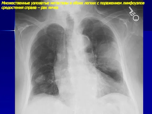 Множественные узловатые метастазы в обоих легких с поражением лимфоузлов средостения справа – рак яичка