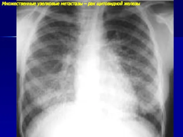 Множественные узелковые метастазы – рак щитовидной железы