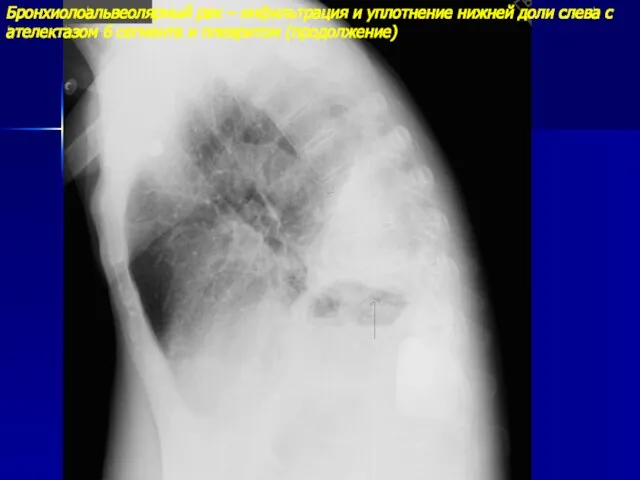 Бронхиолоальвеолярный рак – инфильтрация и уплотнение нижней доли слева с ателектазом 6 сегмента и плевритом (продолжение)