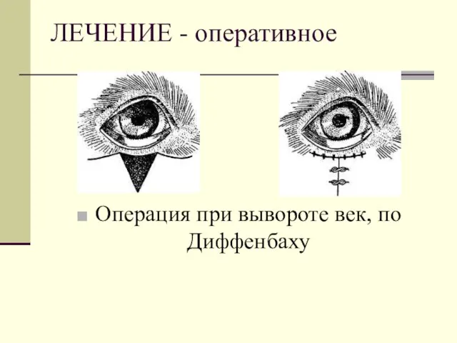 ЛЕЧЕНИЕ - оперативное Операция при вывороте век, по Диффенбаху