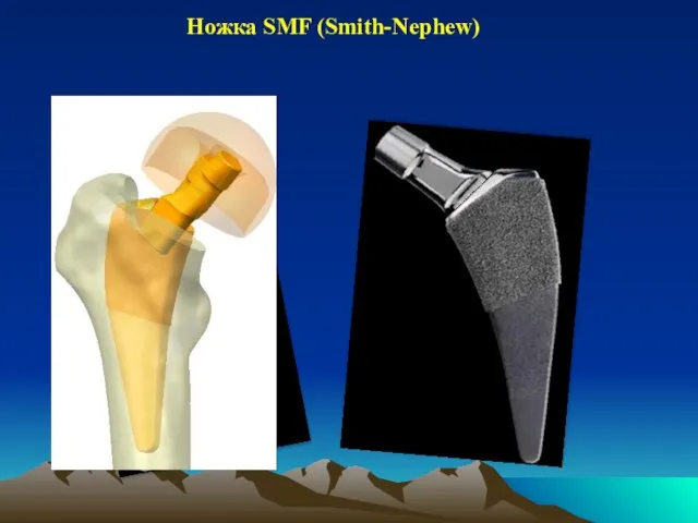 Ножка SMF (Smith-Nephew)