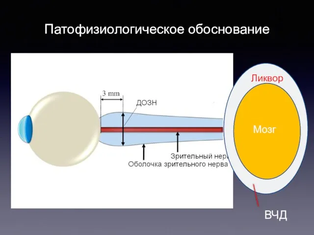 Патофизиологическое обоснование Мозг Ликвор ВЧД