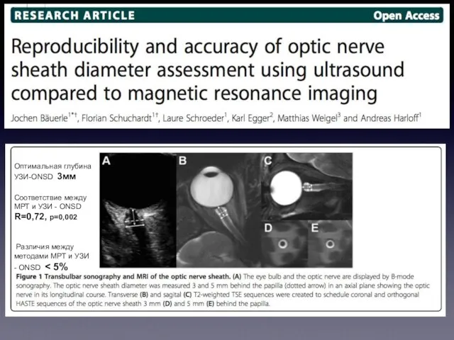 Оптимальная глубина УЗИ-ONSD 3мм Соответствие между МРТ и УЗИ - ONSD